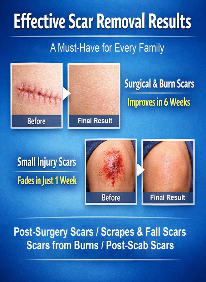 موروفان جل موروفان لإزالة الندبات بالسيليكون: كريم للندبات للجسم والوجه، يقلل بشكل فعال من ظهور الندبات الناتجة عن علامات التمدد، والندبات الجراحية، والجُدرات، وحب الشباب، والحروق، وغيرها. يُظهر الندبات الجديدة خلال 6 أسابيع. - Image 3